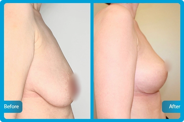 Before After