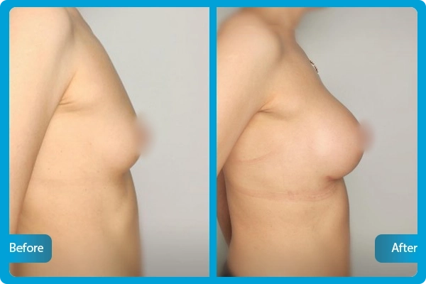 Before After
