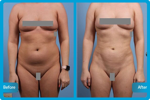 Before After