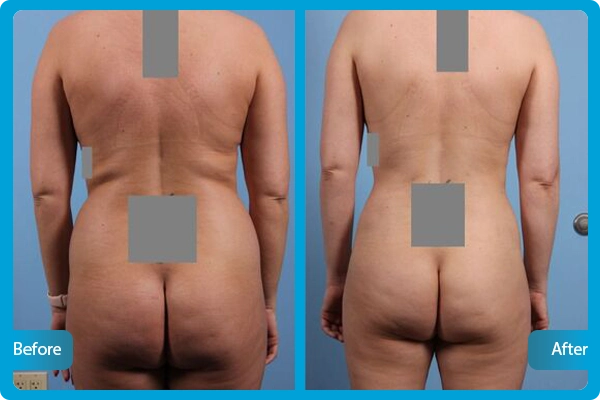 Before After