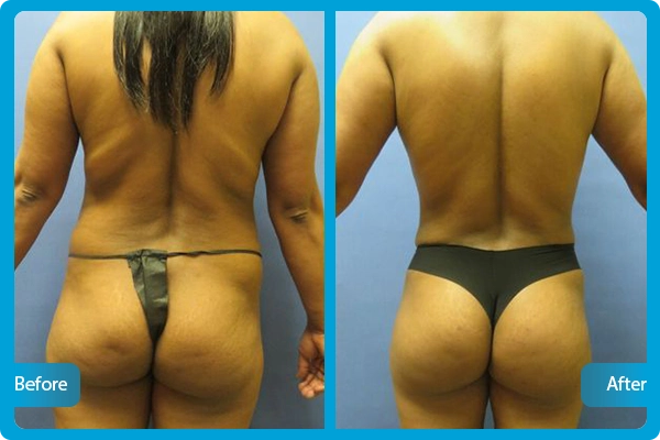 Before After