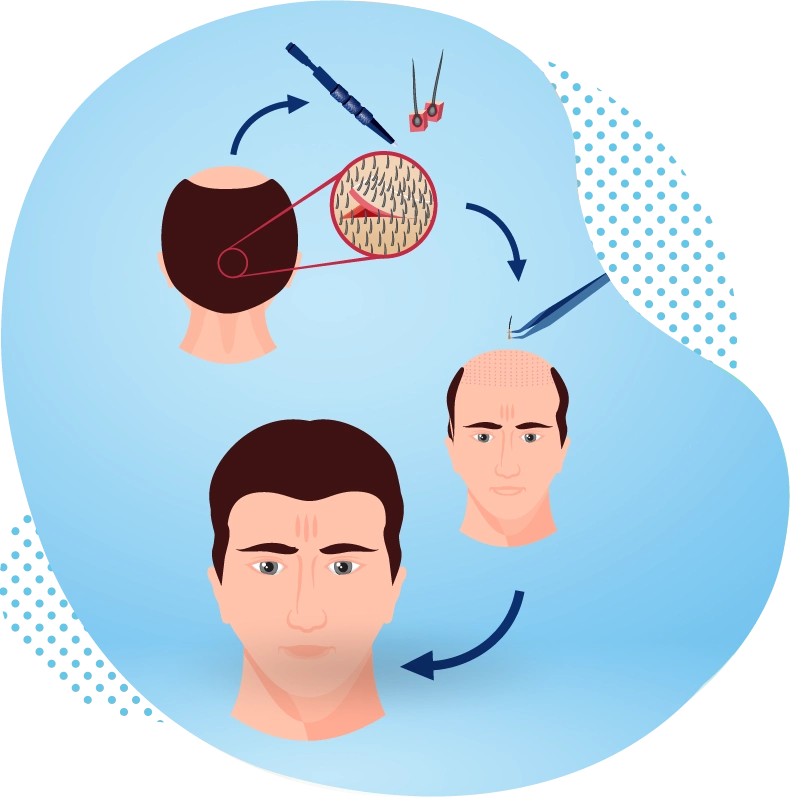 FUE-Haartransplantation in der Turkei - Ablauf