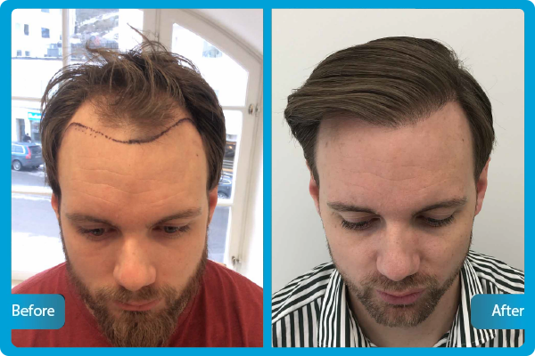 Greffe de cheveux Turquie Avant Après​
