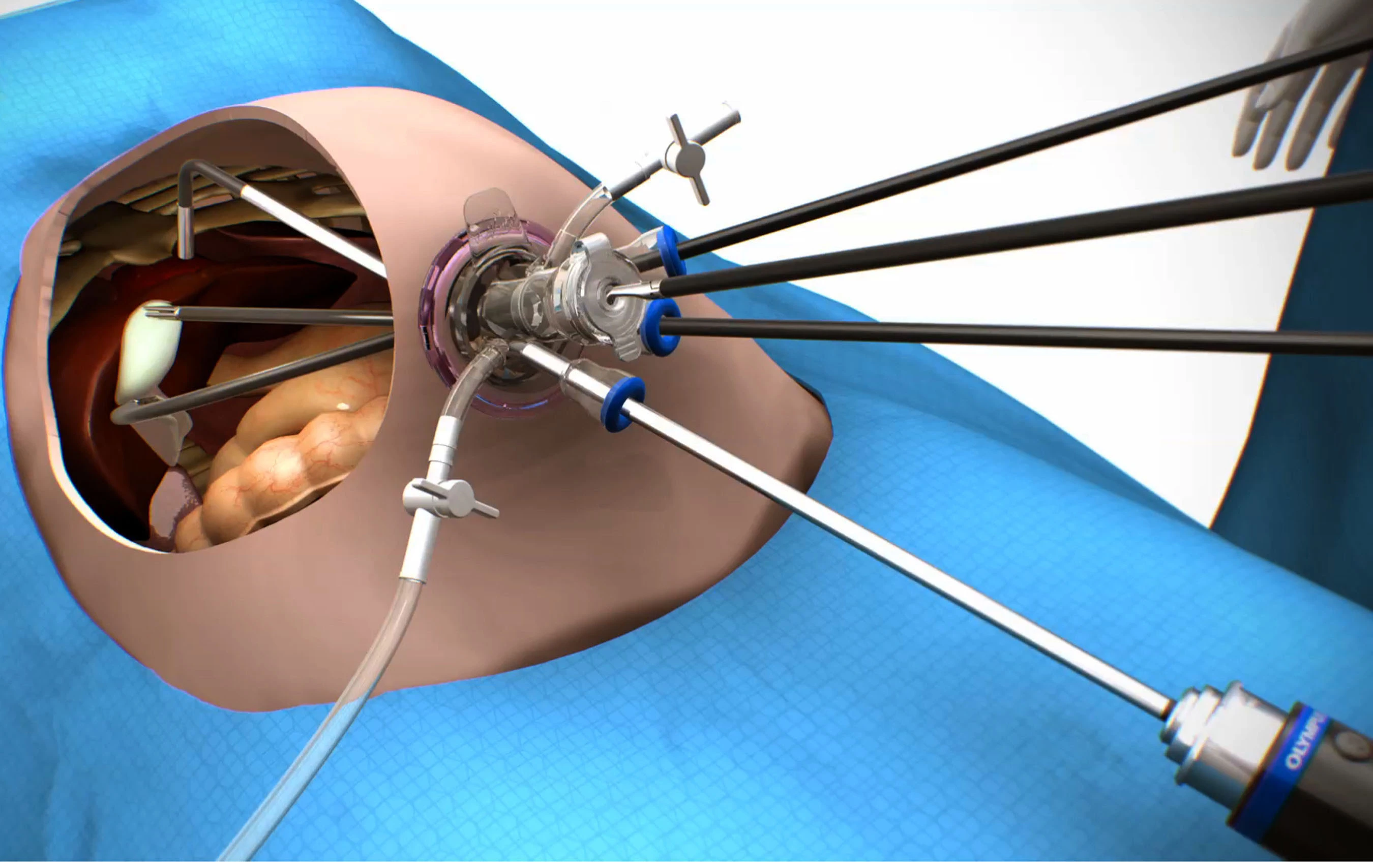 Magenverkleinerung ohne Narbe SILS-Methode-Single-Incision-Laparoscopic-Surgery Schlauchmagen narbenfrei Schlauchmagen Türkei ohne Narbe SILS-Methode
