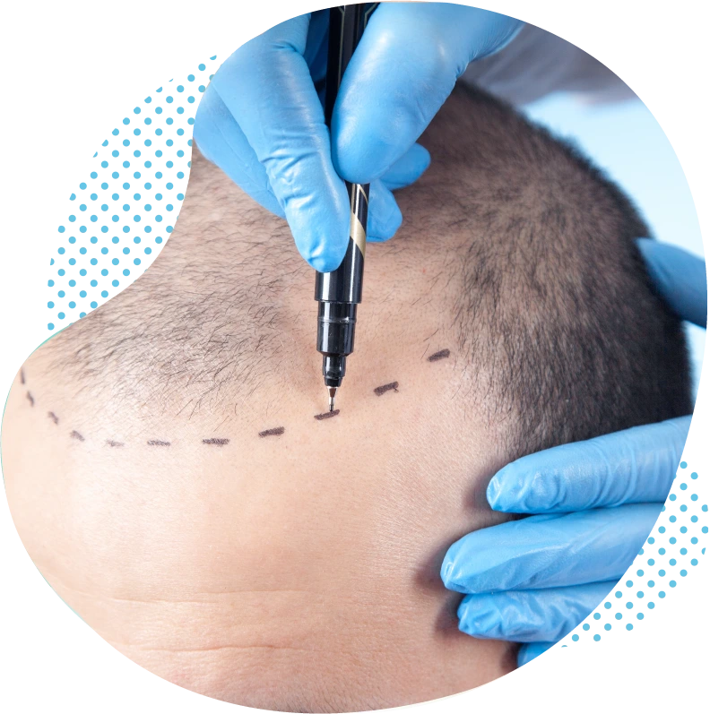 Saphir-Methode oder FUE-Methode Haartransplantation Aesthetic Travel