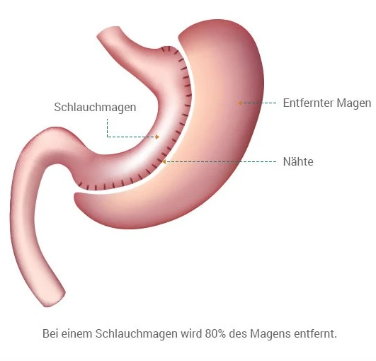 Schlauchmagen ohne Narbe Türkei – Kosten (Alles inklusive Paket)​