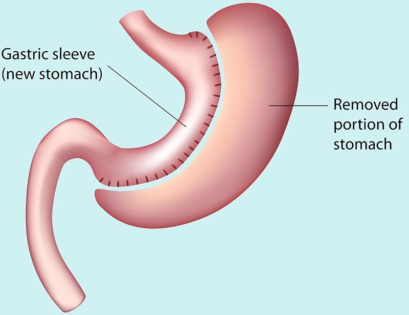 Weight Loss Surgery Without Scars scarless gastric sleeve obesity bariatric