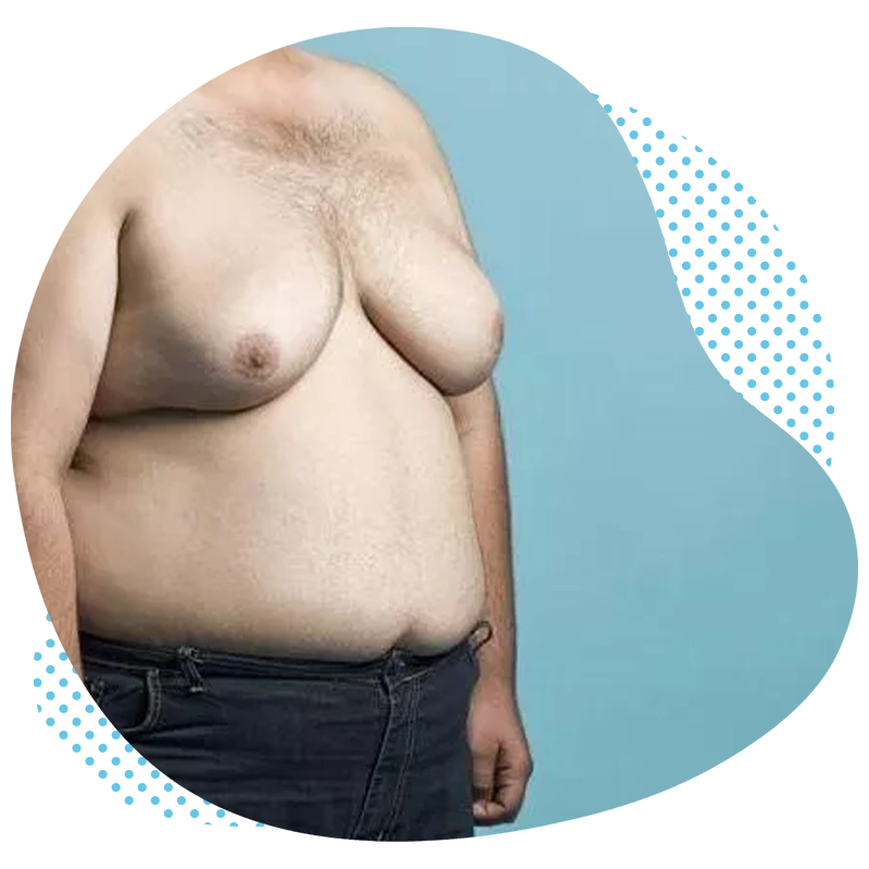 Gynaecomastia turkey antalya