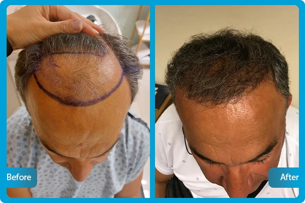 haartransplantation-vorher-nachhe