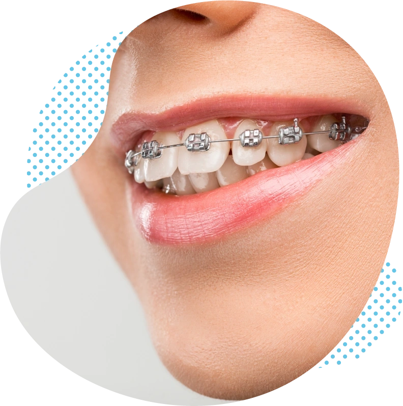 Orthodontia in turkey cost