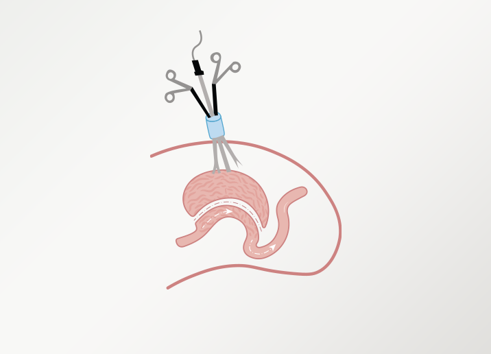 chirurgie-laparoscopique-a-incision-unique-turkei