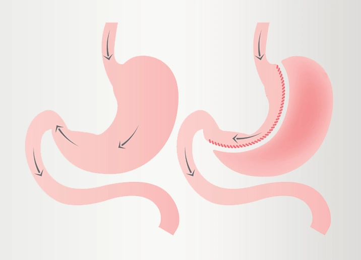 Bariatric Surgery in Turkey 1 sleevegastrectomy turkey